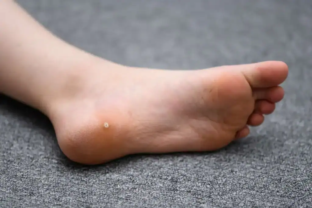 Cryotherapy For Warts And Also Verrucas 2 Image of verruca on the bottom of the foot that able to be treated with Cryotherapy Rainham