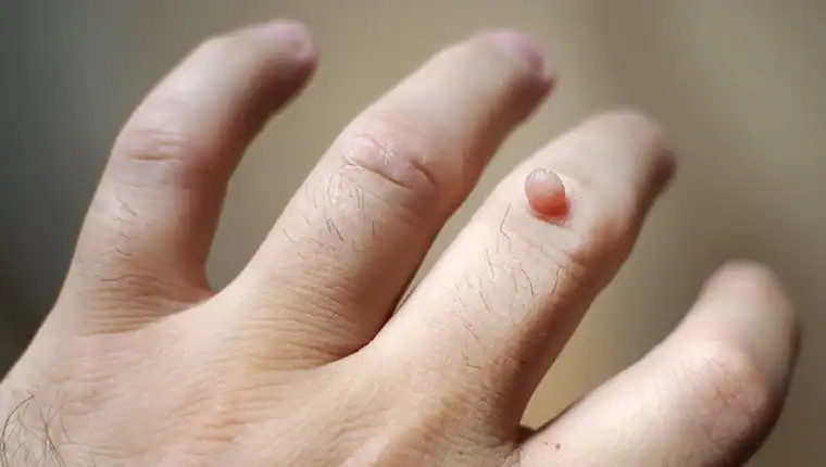 Image of blemish that Cryotherapy Rainham can remove with Lipo 360.