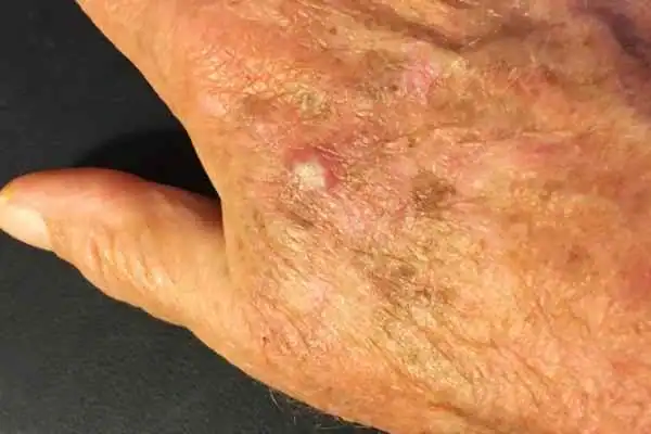 Cryopen For Actinic Keratoses 1 Image of Actinic keratoses Rainham on a person hand