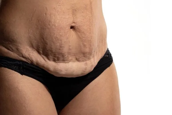 The Science of Skin Tightening 1 The science behind skin tightening Rainham picture of a woman's sagging skin on the stomach